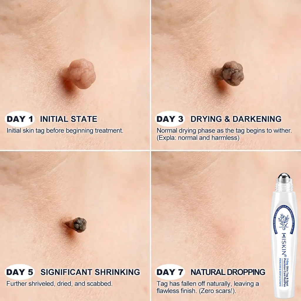 𝐇𝒊𝗦𝙆𝒊𝗡®👩‍⚕️ 𝟕-𝐃𝒂𝘆 𝐒𝗸𝐢𝐧 𝐓𝒂𝗴 & 𝐒𝐩𝙤𝐭 𝐄𝐫𝒂𝐬𝙚𝐫 Painless & Scar-Free Advanced Imperfection Removal Rollerball Pen
