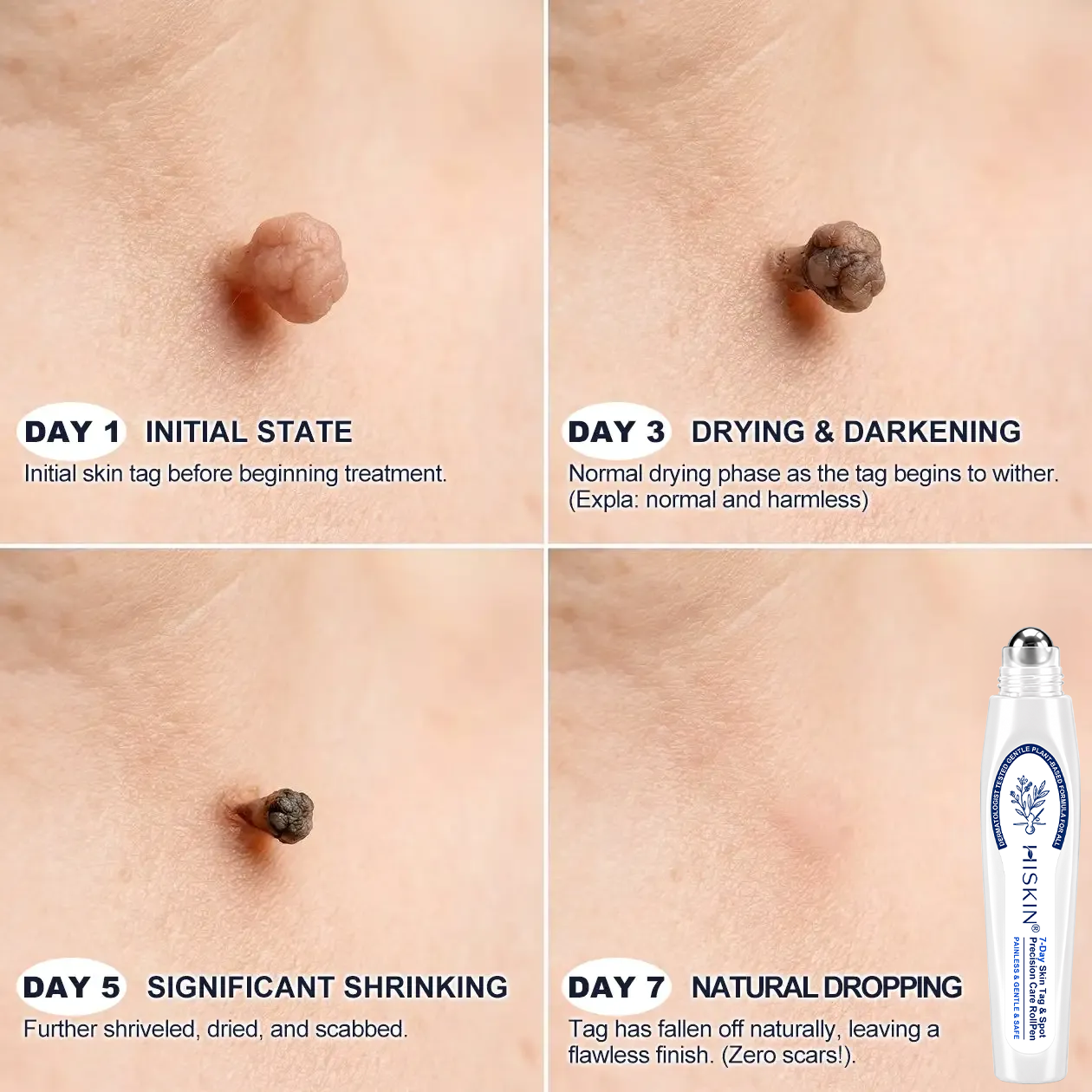 𝐇𝒊𝗦𝙆𝒊𝗡®👩‍⚕️ 𝟕-𝐃𝒂𝘆 𝐒𝗸𝐢𝐧 𝐓𝒂𝗴 & 𝐒𝐩𝙤𝐭 𝐄𝐫𝒂𝐬𝙚𝐫 Painless & Scar-Free Advanced Imperfection Removal Rollerball Pen
